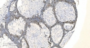 IHC staining of FFPE human ovarian cancer tissue with Coronin 1a antibody. HIER: boil tissue sections in pH8 EDTA for 20 min and allow to cool before testing.