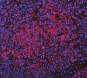 Immunofluorescent staining of FFPE human pancreas cancer tissue with Glutamic-oxaloacetic transaminase 1 antibody (red) and DAPI nuclear stain (blue). HIER: steam section in pH8 EDTA buffer for 20 min.