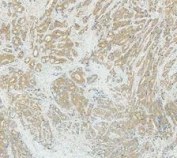IHC staining of FFPE human stomach cancer tissue with Glutamic-oxaloacetic transaminase 1 antibody, HRP-secondary and DAB substrate. HIER: boil tissue sections in pH8 EDTA for 20 min and allow to cool before testing.