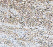 IHC staining of FFPE human bladder cancer tissue with Glutamic-oxaloacetic transaminase 1 antibody, HRP-secondary and DAB substrate. HIER: boil tissue sections in pH8 EDTA for 20 min and allow to cool before testing.