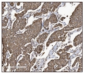 IHC staining of FFPE human breast cancer tissue with Glutamate-oxaloacetate transaminase 2 antibody. HIER: boil tissue sections in pH8 EDTA for 20 min and allow to cool before testing.