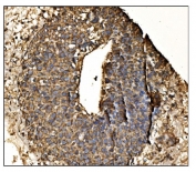 IHC staining of FFPE human liver cancer tissue with Antizyme inhibitor 2 antibody. HIER: boil tissue sections in pH8 EDTA for 20 min and allow to cool before testing.