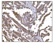IHC staining of FFPE human ovarian cancer tissue with LRP1B antibody. HIER: boil tissue sections in pH8 EDTA for 20 min and allow to cool before testing.
