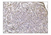 IHC staining of FFPE human liver cancer tissue with Nudel antibody. HIER: boil tissue sections in pH8 EDTA for 20 min and allow to cool before testing.