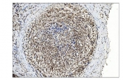 IHC staining of FFPE human gallbladder adenocarcinoma tissue with SUMO2/3 antibody. HIER: boil tissue sections in pH8 EDTA for 20 min and allow to cool before testing.