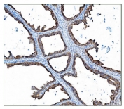 IHC staining of FFPE human ovarian cancer tissue with TBC1D4 antibody. HIER: boil tissue sections in pH8 EDTA for 20 min and allow to cool before testing.