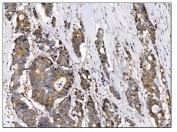IHC staining of FFPE human colonic adenocarcinoma tissue with TBC1D4 antibody. HIER: boil tissue sections in pH8 EDTA for 20 min and allow to cool before testing.