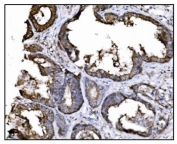 IHC staining of FFPE human colon cancer tissue with HSP90AA1 antibody. HIER: boil tissue sections in pH8 EDTA for 20 min and allow to cool before testing.