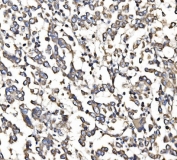IHC staining of FFPE human pancreatic cancer tissue with 5HT1B antibody. HIER: boil tissue sections in pH8 EDTA for 20 min and allow to cool before testing.