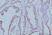 IHC staining of FFPE human colonic adenocarcinoma tissue with EIF4A1 antibody. HIER: boil tissue sections in pH8 EDTA for 20 min and allow to cool before testing.