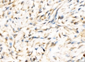 IHC staining of FFPE human breast cancer tissue with AP2A2 antibody. HIER: boil tissue sections in pH8 EDTA for 20 min and allow to cool before testing.