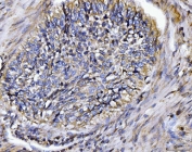 IHC staining of FFPE human lung cancer tissue with BIN1 antibody. HIER: boil tissue sections in pH8 EDTA for 20 min and allow to cool before testing.