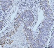 IHC staining of FFPE human liver cancer tissue with ETFA antibody. HIER: boil tissue sections in pH8 EDTA for 20 min and allow to cool before testing.