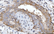IHC staining of FFPE human breast cancer tissue with GNB3 antibody. HIER: boil tissue sections in pH8 EDTA for 20 min and allow to cool before testing.