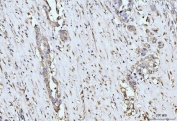 IHC staining of FFPE human appendiceal adenocarcinoma tissue with MOV10 antibody. HIER: boil tissue sections in pH8 EDTA for 20 min and allow to cool before testing.