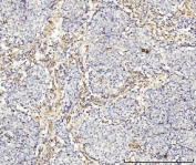 IHC staining of FFPE human lung cancer tissue with MT-ND5 antibody. HIER: boil tissue sections in pH8 EDTA for 20 min and allow to cool before testing.