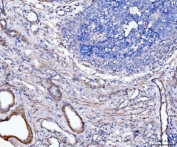 IHC staining of FFPE human bladder epithelial carcinoma tissue with MT-ND5 antibody. HIER: boil tissue sections in pH8 EDTA for 20 min and allow to cool before testing.