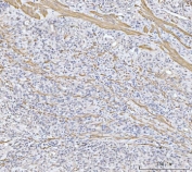 IHC staining of FFPE human gastric cancer tissue with MT-ND5 antibody. HIER: boil tissue sections in pH8 EDTA for 20 min and allow to cool before testing.