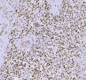IHC staining of FFPE human testicular cancer tissue with Synaptonemal Complex Protein 3 antibody. HIER: boil tissue sections in pH8 EDTA for 20 min and allow to cool before testing.