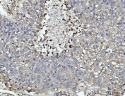 IHC staining of FFPE human liver cancer tissue with DUSP6 antibody. HIER: boil tissue sections in pH8 EDTA for 20 min and allow to cool before testing.