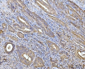 IHC staining of FFPE human gall bladder adenosquamous carcinoma tissue with Aldehyde Dehydrogenase 1A1 antibody. HIER: boil tissue sections in pH8 EDTA for 20 min and allow to cool before testing.