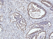 IHC staining of FFPE human rectal moderately differentiate adenocarcinoma tissue with MCM6 antibody. HIER: boil tissue sections in pH8 EDTA for 20 min and allow to cool before testing.