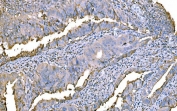 IHC staining of FFPE human colorectal cancer tissue with Prothrombin antibody. HIER: boil tissue sections in pH8 EDTA for 20 min and allow to cool before testing.