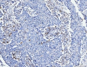 IHC staining of FFPE human lung cancer tissue with ACSL4 antibody. HIER: boil tissue sections in pH8 EDTA for 20 min and allow to cool before testing.