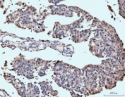 IHC staining of FFPE human bladder epithelial carcinoma tissue with Neurofibromin antibody. HIER: boil tissue sections in pH8 EDTA for 20 min and allow to cool before testing.