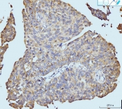 IHC staining of FFPE human bladder epithelial carcinoma tissue with NF1 antibody. HIER: boil tissue sections in pH8 EDTA for 20 min and allow to cool before testing.