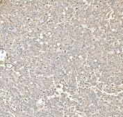 IHC staining of FFPE human liver cancer tissue with Pyruvate Kinase antibody. HIER: boil tissue sections in pH8 EDTA for 20 min and allow to cool before testing.