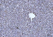 IHC staining of FFPE mouse liver cancer tissue with CTSB antibody. HIER: boil tissue sections in pH8 EDTA for 20 min and allow to cool before testing.