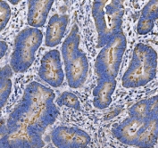 IHC staining of FFPE moderately differentiated adenocarcinoma of the human rectum with MUC-1 antibody. HIER: boil tissue sections in pH8 EDTA for 20 min and allow to cool before testing.