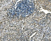IHC staining of FFPE human lung cancer tissue with RAB13 antibody. HIER: boil tissue sections in pH8 EDTA for 20 min and allow to cool before testing.