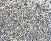 IHC staining of FFPE human lymphoma tissue with RAB13 antibody. HIER: boil tissue sections in pH8 EDTA for 20 min and allow to cool before testing.