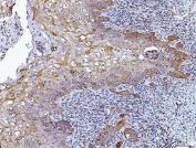 IHC staining of FFPE human laryngeal squamous cell carcinoma tissue with HRS antibody. HIER: boil tissue sections in pH8 EDTA for 20 min and allow to cool before testing.