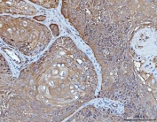 IHC staining of FFPE human laryngeal squamous cell carcinoma tissue with YWHAE antibody. HIER: boil tissue sections in pH8 EDTA for 20 min and allow to cool before testing.