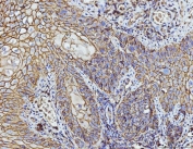IHC staining of FFPE human laryngeal squamous cell carcinoma tissue with CD147 antibody. HIER: boil tissue sections in pH8 EDTA for 20 min and allow to cool before testing.