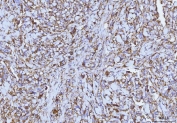 IHC staining of FFPE human breast infiltrating ductal carcinoma tissue with CD147 antibody. HIER: boil tissue sections in pH8 EDTA for 20 min and allow to cool before testing.