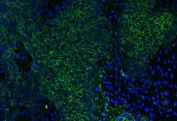 Immunofluorescent staining of FFPE human esophageal squamous carcinoma tissue with CD147 antibody (green) and DAPI nuclear stain (blue). HIER: boil tissue sections in pH8 EDTA for 20 min and allow to cool before testing.