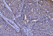 IHC staining of FFPE human hepatocellular carcinoma tissue with Emmprin antibody. HIER: boil tissue sections in pH8 EDTA for 20 min and allow to cool before testing.