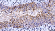 IHC staining of FFPE human laryngeal squamous cell carcinoma tissue with CD55 antibody. HIER: boil tissue sections in pH8 EDTA for 20 min and allow to cool before testing.