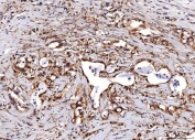IHC staining of FFPE human gastric carcinoma tissue with ENO1 antibody. HIER: boil tissue sections in pH8 EDTA for 20 min and allow to cool before testing.