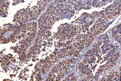 IHC staining of FFPE human bladder epithelial carcinoma tissue with Flap endonuclease 1 antibody. HIER: boil tissue sections in pH8 EDTA for 20 min and allow to cool before testing.