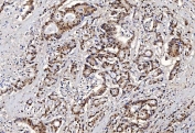 IHC staining of FFPE human colorectal adenocarcinoma tissue with Flap endonuclease 1 antibody. HIER: boil tissue sections in pH8 EDTA for 20 min and allow to cool before testing.