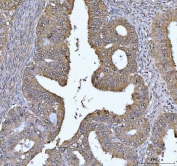 IHC staining of FFPE human endometrial cancer tissue with FEN1 antibody. HIER: boil tissue sections in pH8 EDTA for 20 min and allow to cool before testing.