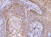IHC staining of FFPE human laryngeal squamous cell carcinoma tissue with AHSA1 antibody. HIER: boil tissue sections in pH8 EDTA for 20 min and allow to cool before testing.