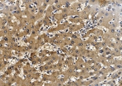 IHC staining of FFPE human liver cancer tissue with Proteasome 20S beta 7 antibody. HIER: boil tissue sections in pH8 EDTA for 20 min and allow to cool before testing.