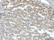 IHC staining of FFPE human liver cancer tissue with Aldehyde dehydrogenase 3 antibody. HIER: boil tissue sections in pH8 EDTA for 20 min and allow to cool before testing.