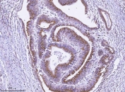 IHC staining of FFPE human rectal cancer tissue with ALDH3 antibody. HIER: boil tissue sections in pH8 EDTA for 20 min and allow to cool before testing.
